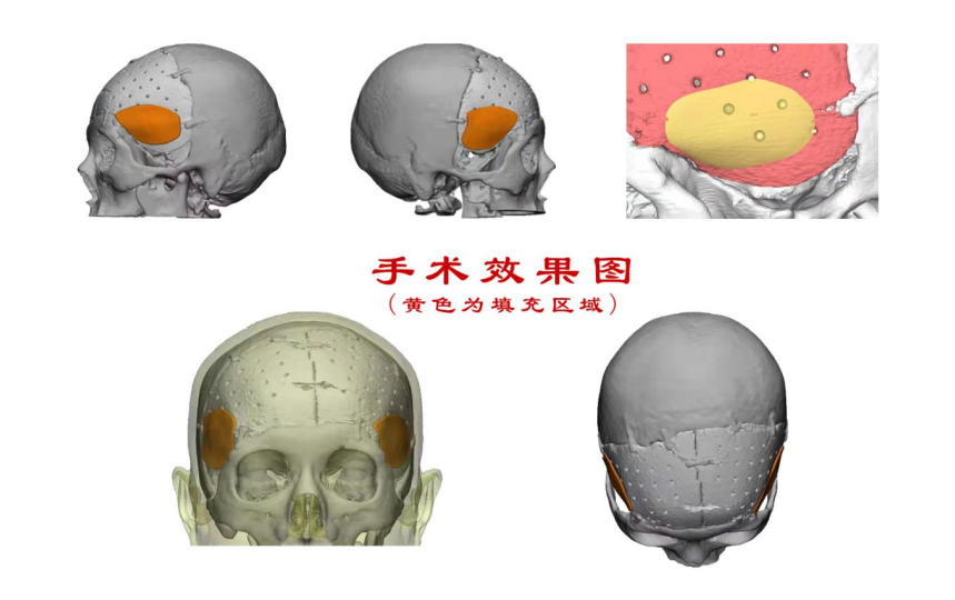 林志穎車禍致顏面骨折，醫(yī)生：或可用3D打印建模進行術后修復