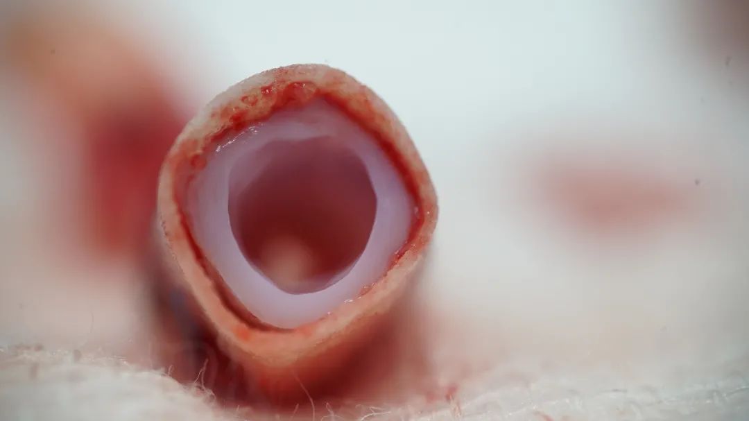 全球首款干細胞3D生物打印產(chǎn)品獲得國家衛(wèi)生健康委員會的臨床批準(zhǔn)